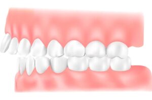 出っ歯(上顎前突:じょうがくぜんとつ)のイラスト