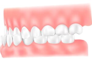 受け口(下顎前突:かがくぜんとつ)のイラスト