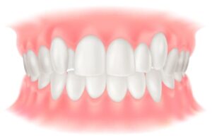 八重歯・乱ぐい歯(叢生:そうせい)のイラスト